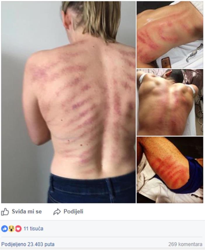Frizerka-petehije