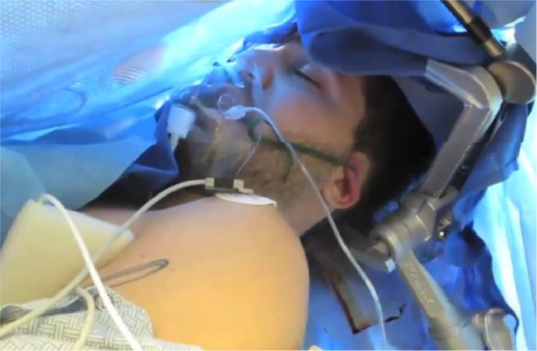VIDEO: Snimao operaciju vlastitog mozga tijekom koje je bio budan 