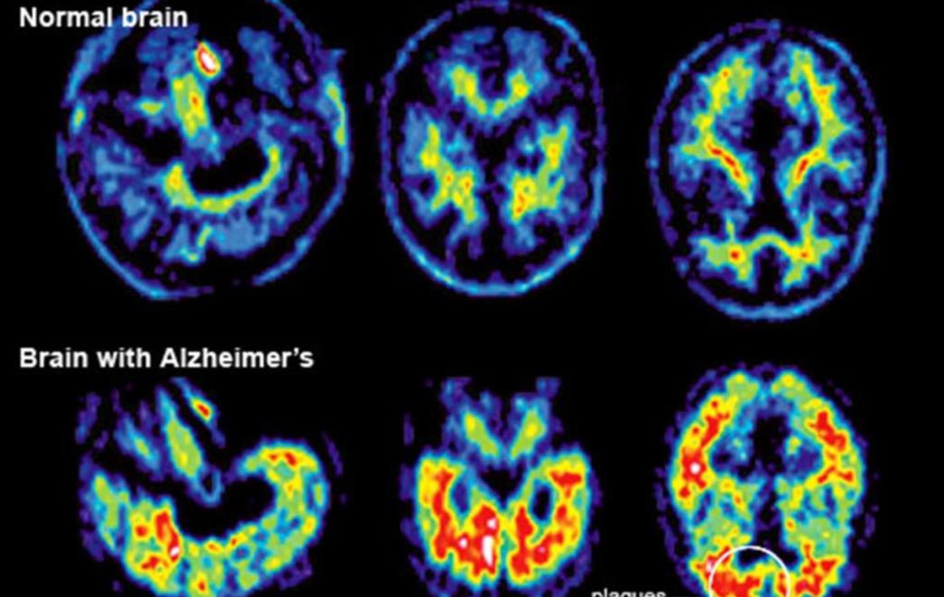 SIMPTOMI  NEMAJU VEZE SA ZABORAVLJANJEM Ovo su četiri znaka koja otkrivaju Alzheimer