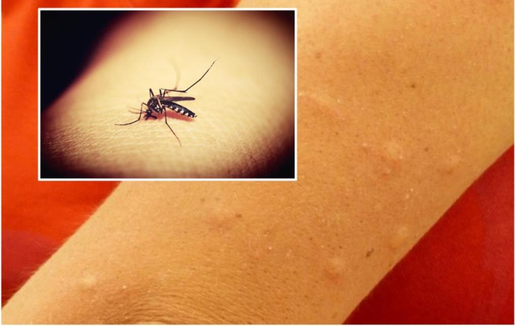 Pitali  smo stručnjake: Zbog čega komarci neke ljude 'vole' više od drugih?