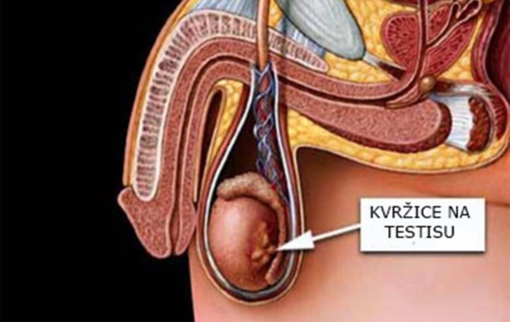 Kvržica na  testisu – uzroci, simptomi, liječenje