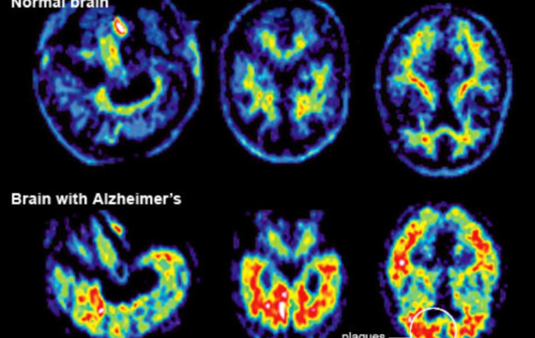 Nova otkrića o širenju Alzheimerove bolesti
