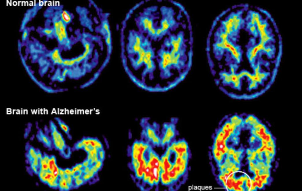 Neobrazovani i pušači će najprije dobiti Alzheimerovu bolest
