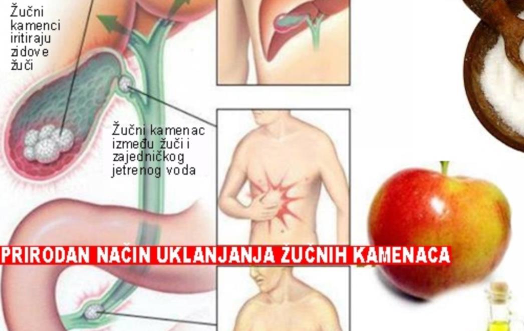 RECEPT KINESKOG DOKTORA KOJI JE SPASIO MNOGE: Prirodan način otklanjanja žučnih kamenaca