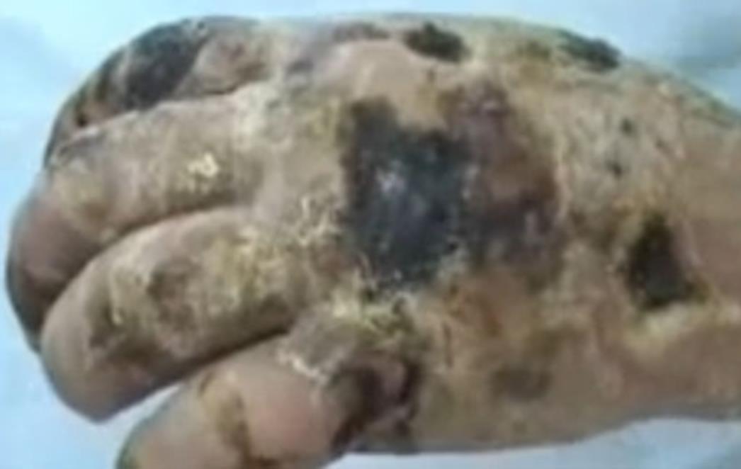 UZNEMIRUJUĆI VIDEO: Šokantne snimke raspadanja tijela zbog droge 'Krokodil'