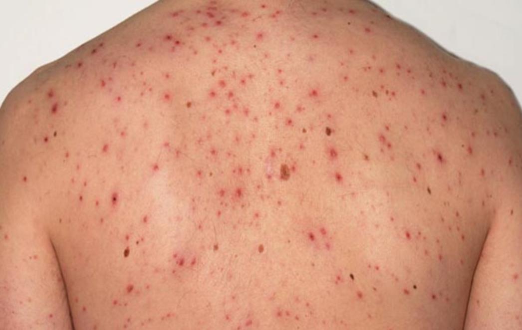 EPIDEMIJA PRED VRATIMA: Potvrđeno koji dio Hrvatske je najviše pogođen opasnim virusom, odmah se javite