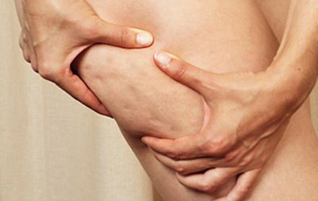 Celulit je gola istina za 80 posto žena