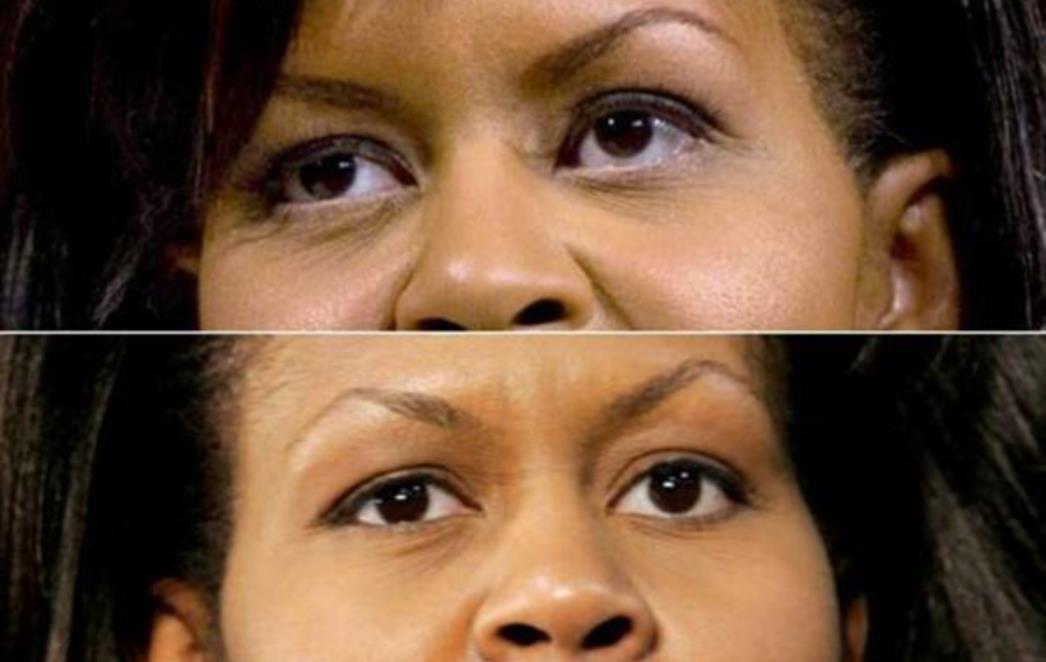 Čarima botoksa nije odoljela ni Michelle Obama?