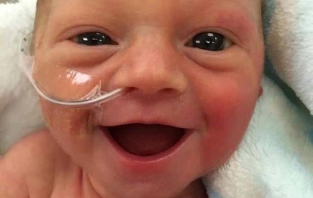 SVJETSKI DAN PRIJEVREMENO ROĐENE DJECE Kratkoročne komplikacije kod nedonoščadi