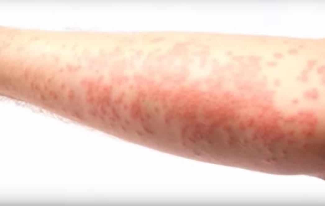  Neurodermatitis – uzroci,   simptomi i liječenje