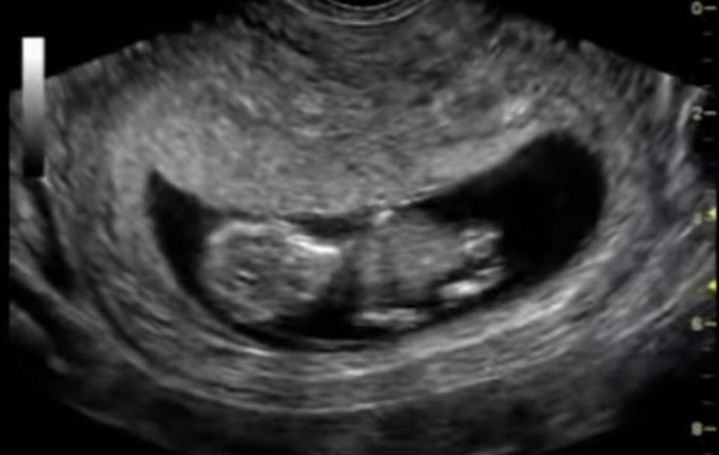 ISPRIČALA    SVOJU ISTINU Ova žena napravila je 40 tisuća abortusa (VIDEO)
