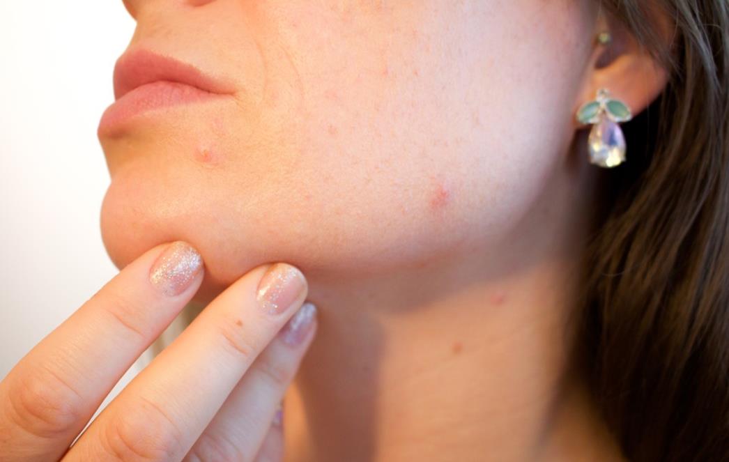  Prepoznajte simptome  hormonalne neravnoteže