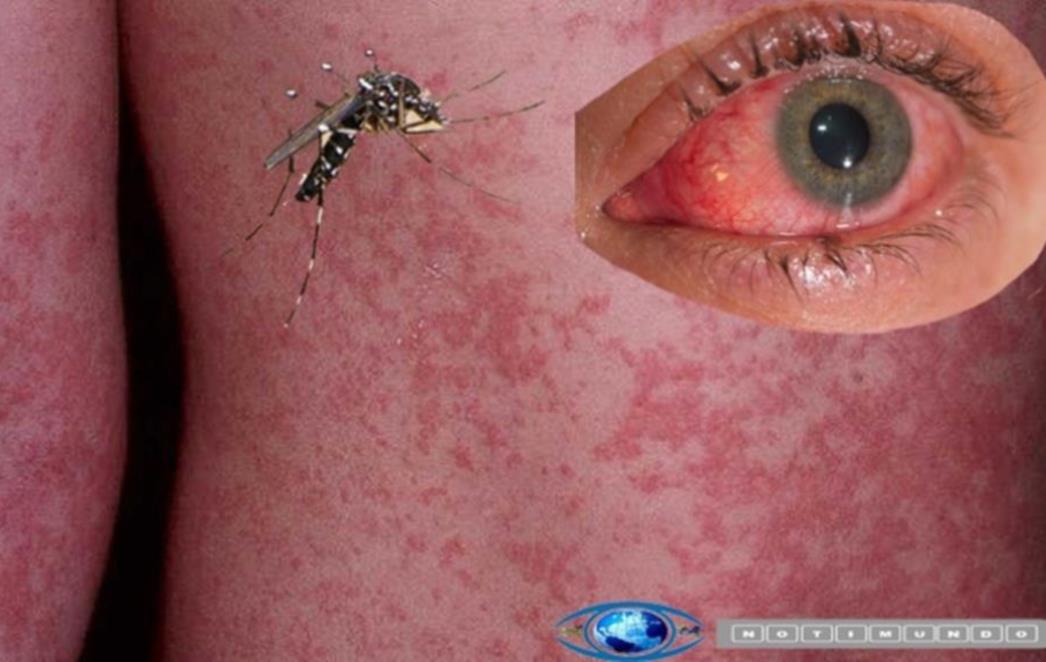 Krizni sastanak zbog epidemije virusa koji  ugrožava trudnice; Mogao bi zaraziti 3 do 4 milijuna ljudi!