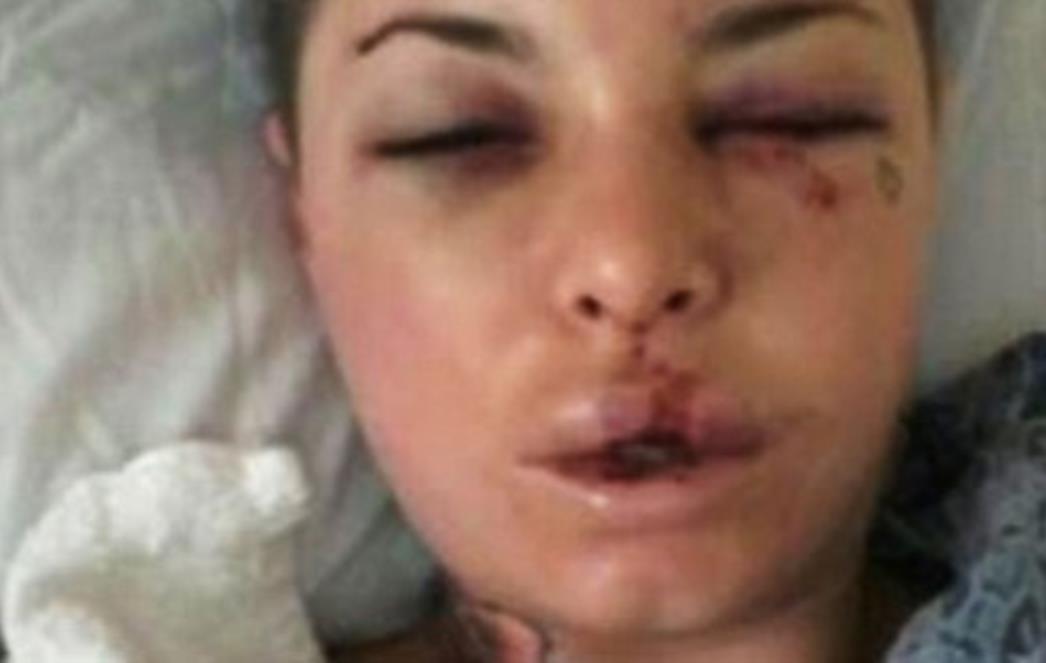 GLUMICA OBJAVILA FOTOGRAFIJE: Brutalno je pretukao poznati MMA borac (FOTO)