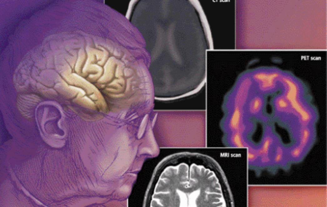 Prvi znak teške demencije je problem sa snom