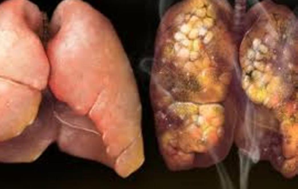 Pluća pušača kao u osoba koje boluju od cistične fibroze