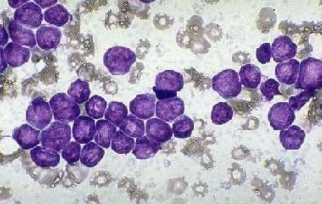 Rak dojke sve češći u mlađih žena, krive su moderne navike