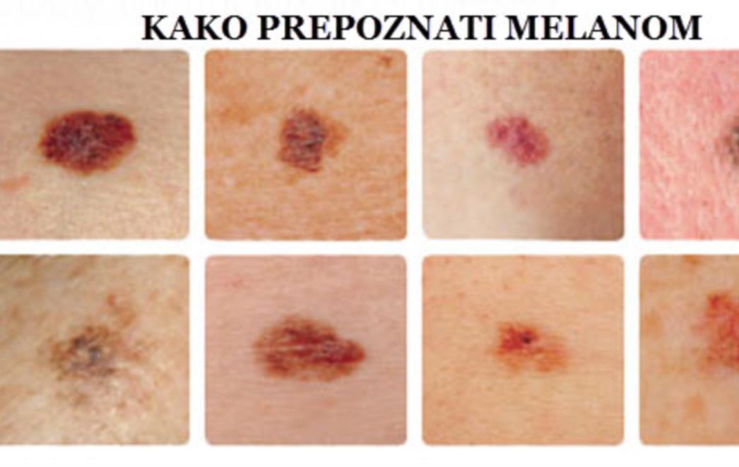OPASNI MADEŽI! Skinite aplikaciju i u samo nekoliko sekundi otkrijte imate li melanom! 