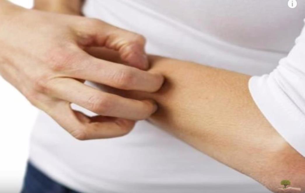 Lišaj  na koži (ringworm) – kako  ga prepoznati i liječiti?