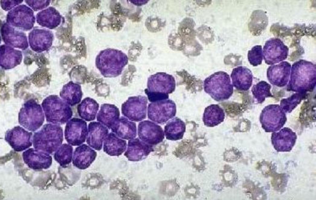 NOVO OTKRIĆE: Promjene metabolizma stanica najavljuju rak?