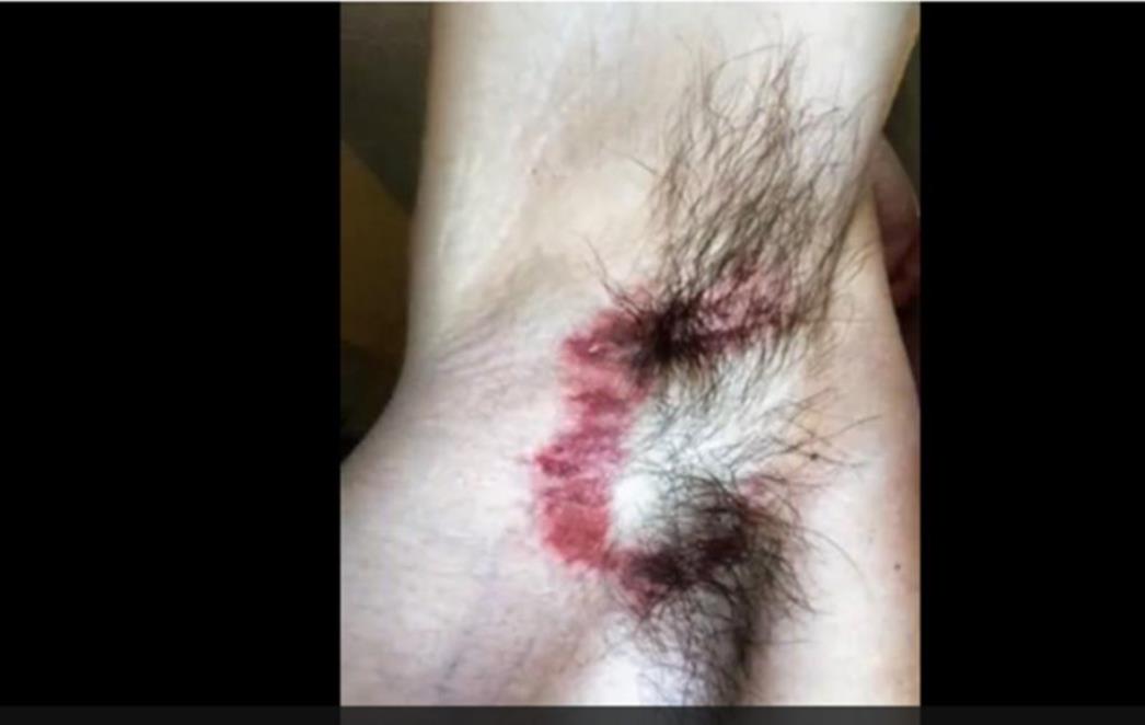 'IMAO SAM OSJEĆAJ DA MI RUKA GORI!' Je li dezodorans uzrokovao osip i opekline?