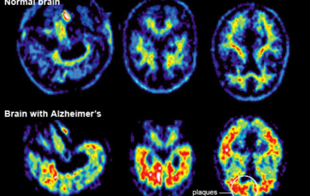Dijabetičari bi u kasnijem životu mogli bolovati od Alzheimerove bolesti