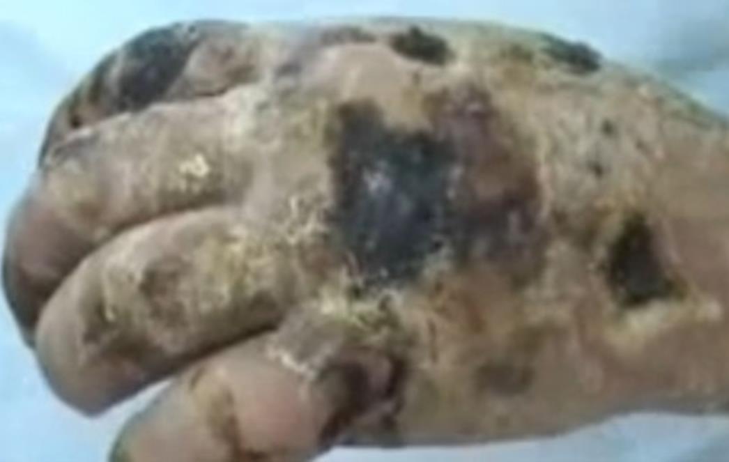 ZASTRAŠUJUĆE: Droga koja 'jede meso' opet na ulicama Srbije, 'Krokodila' izbjegavaju čak i dileri! (UZNEMIRUJUĆI VIDEO)