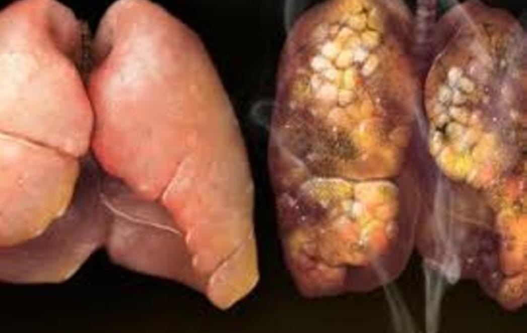 TIJELO VAS UPOZORAVA: Ovo su znakovi raka pluća koje ne smijete ignorirati