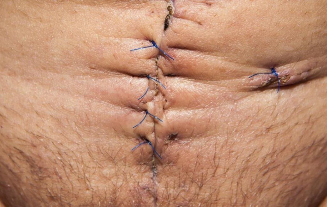 Krema  za ožiljke – ublažite vidljivost i potaknite zacjeljivanje