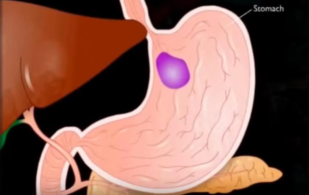 Loš   efekt   antibiotika: Tableta   koja uništava dobre    bakterije u   abdomenu