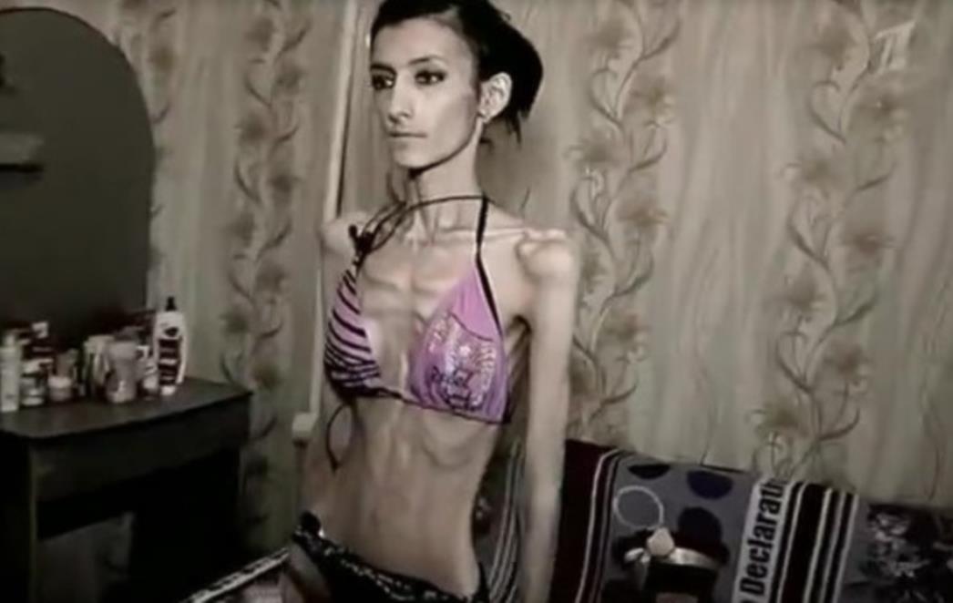 Zastrašujuće posljedice anoreksije: Djevojka koju upravo gledate ima samo 21 kilogram! /VIDEO/