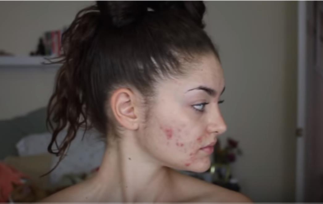 PRIŠTIĆI  NA  LICU  Evo  što  znači  njihova  pojava  na   pojedinim  zonama