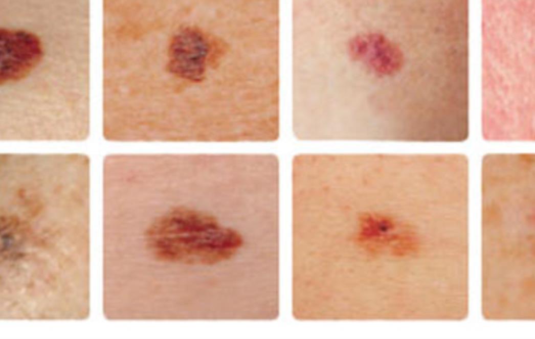 DERMATOLOZI SAVJETUJU: Evo zašto madeže nije dobro uklanjati laserom!