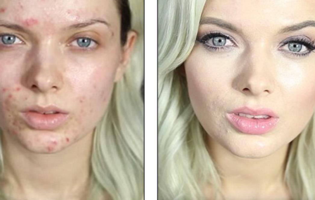 (VIDEO) NEVJEROJATNA PREOBRAZBA Poznata beauty blogerica pokazala kako prikriti grozne akne i opet izgledati privlačno