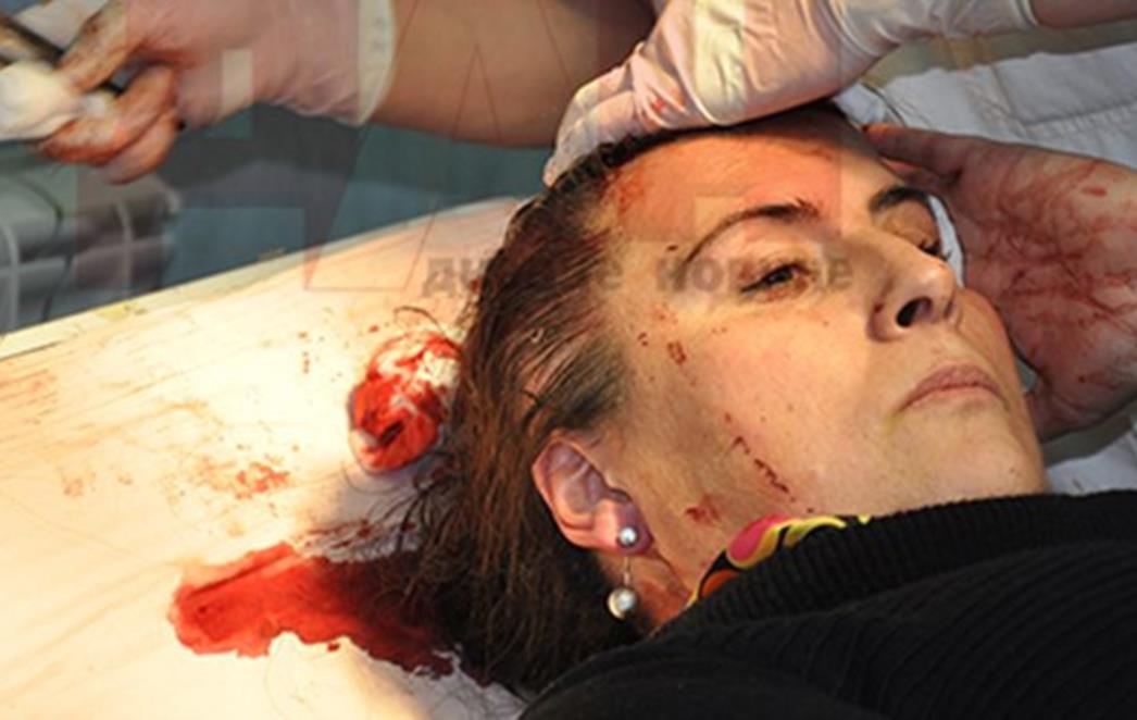 SAČEKUŠA U CRNOJ GORI: Brutalno pretučena novinarka 