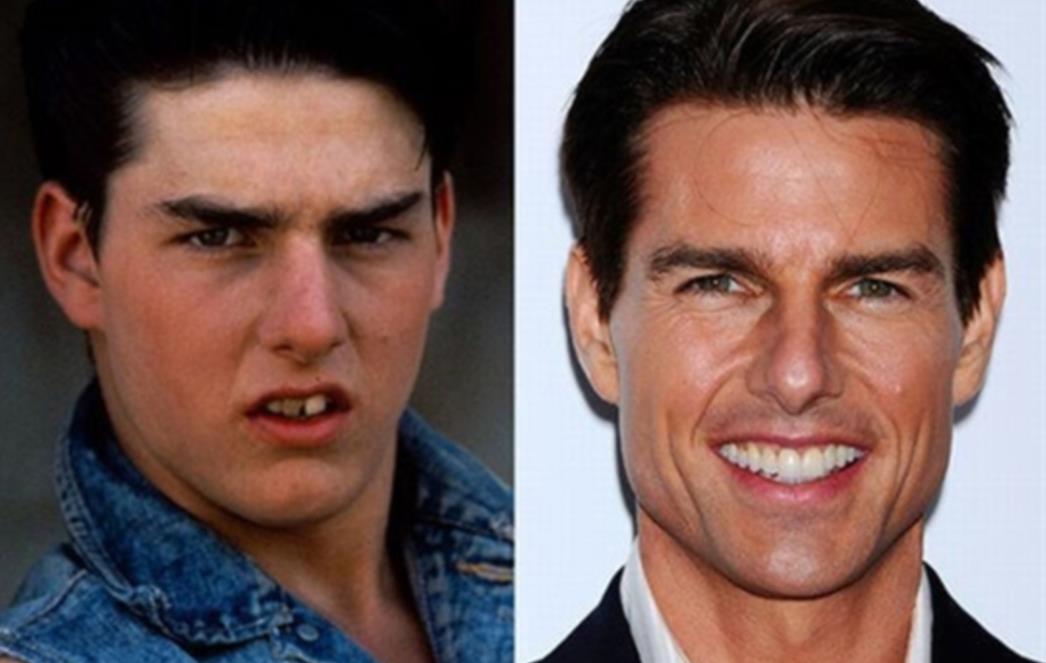 FOTOGRAFIJA DANA: Tom Cruise prije i poslije zubara