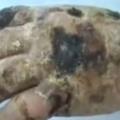 ZASTRAŠUJUĆE: Droga koja 'jede meso' opet na ulicama Srbije, 'Krokodila' izbjegavaju čak i dileri! (UZNEMIRUJUĆI VIDEO)