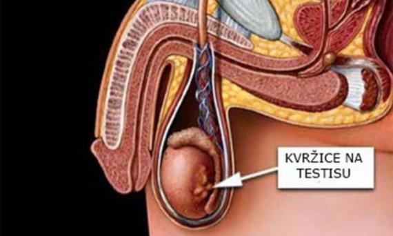 Kvržica na  testisu – uzroci, simptomi, liječenje